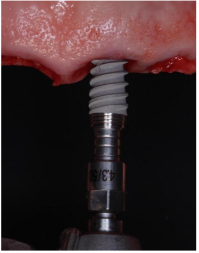 implantes-dentales-titaneo