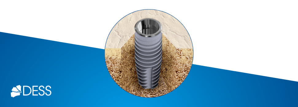 osseointegration dental implants