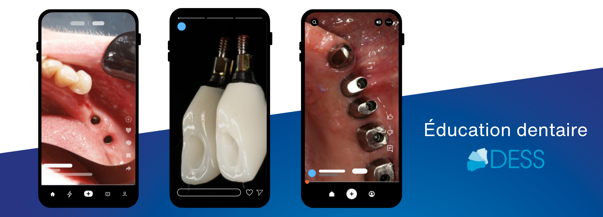 Cas cliniques et chirurgies DESS | Formation pratique pour les professionnels dentaires